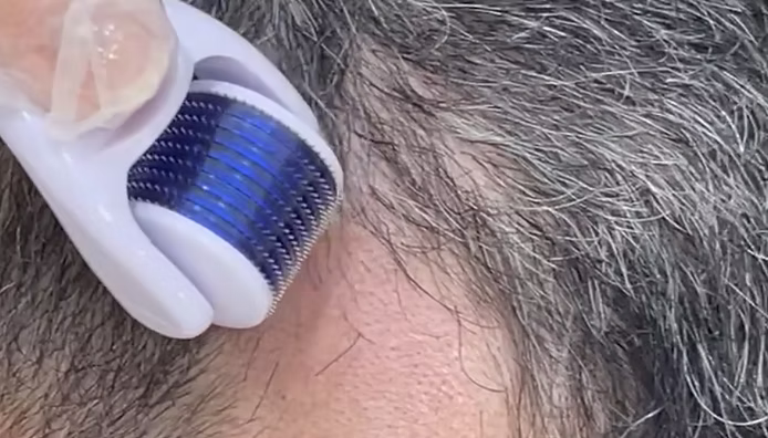 Microagulhamento com infusão de ativos